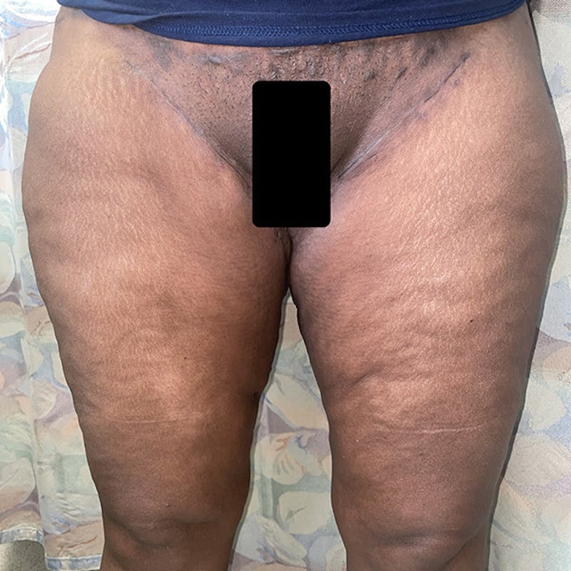 Thigh Lift Before & After Gallery - Patient 283790 - Image 2