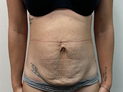 Tummy Tuck Before & After Gallery - Patient 344840 - Image 1