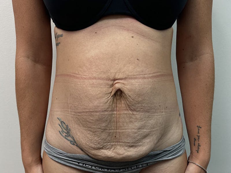 Tummy Tuck Before & After Gallery - Patient 344840 - Image 1