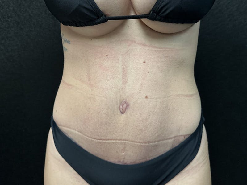 Tummy Tuck Before & After Gallery - Patient 344840 - Image 2