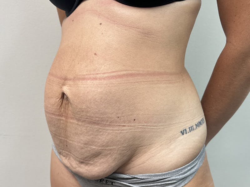 Tummy Tuck Before & After Gallery - Patient 344840 - Image 3
