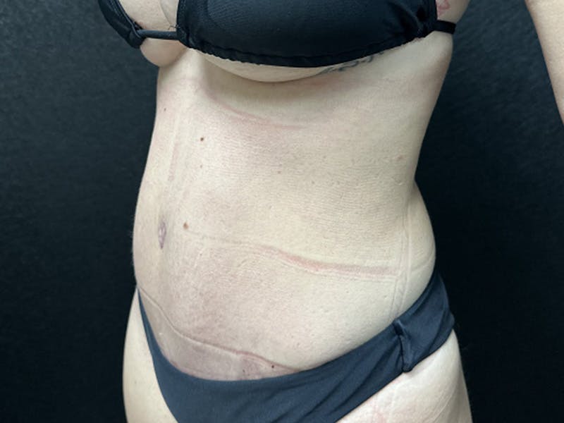 Tummy Tuck Before & After Gallery - Patient 344840 - Image 4