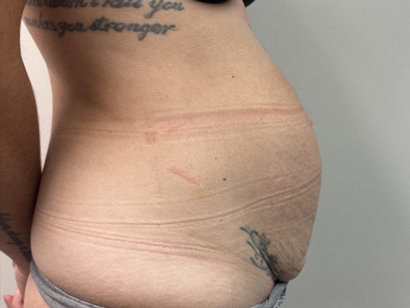 Tummy Tuck Before & After Gallery - Patient 344840 - Image 5