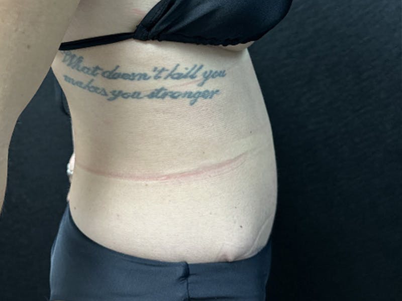 Tummy Tuck Before & After Gallery - Patient 344840 - Image 6