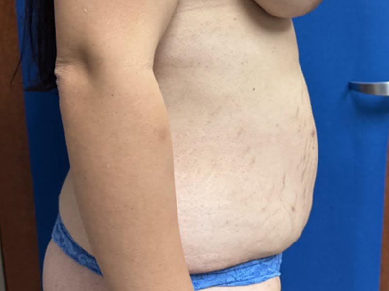 Tummy Tuck Before & After Gallery - Patient 207128 - Image 3