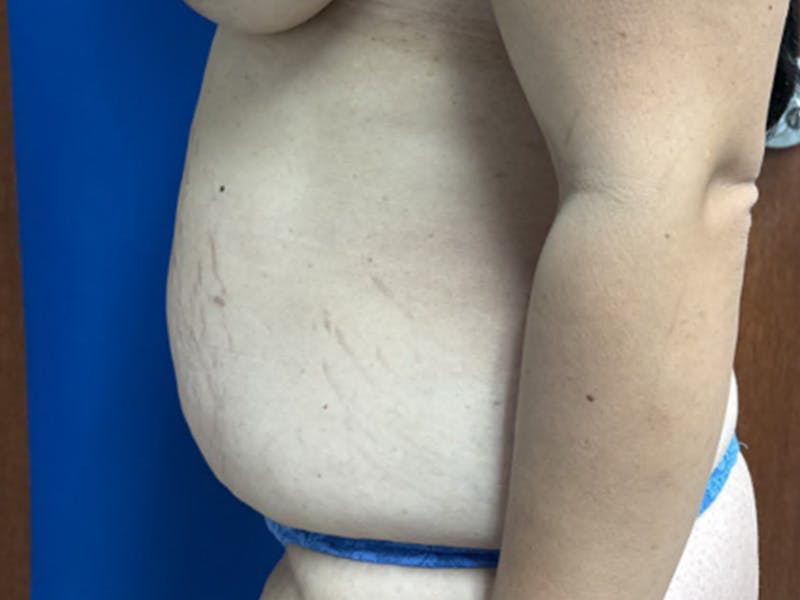 Tummy Tuck Before & After Gallery - Patient 207128 - Image 5
