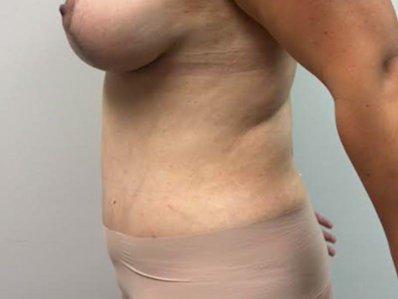 Tummy Tuck Before & After Gallery - Patient 207128 - Image 6