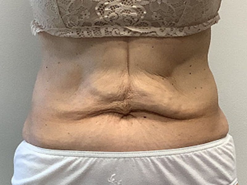 Tummy Tuck Before & After Gallery - Patient 332838 - Image 1