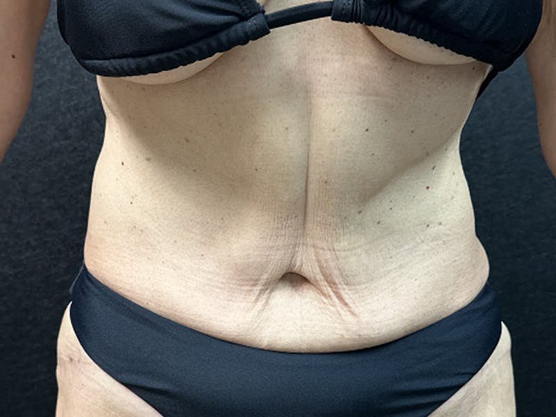 Tummy Tuck Before & After Gallery - Patient 332838 - Image 2