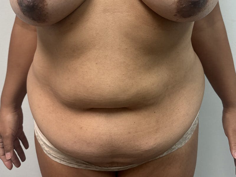 Tummy Tuck Before & After Gallery - Patient 362315 - Image 1