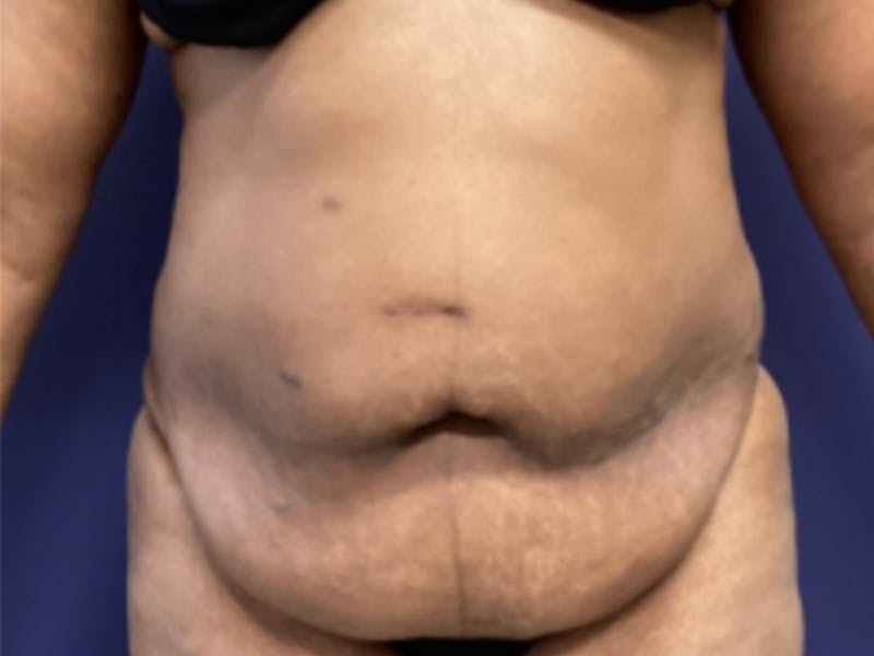 Tummy Tuck Before & After Gallery - Patient 177341 - Image 1