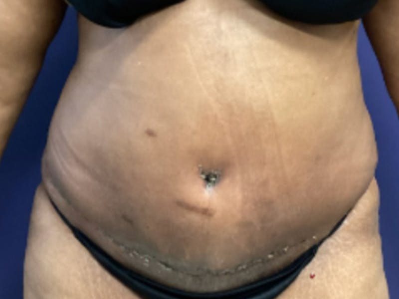 Tummy Tuck Before & After Gallery - Patient 177341 - Image 2