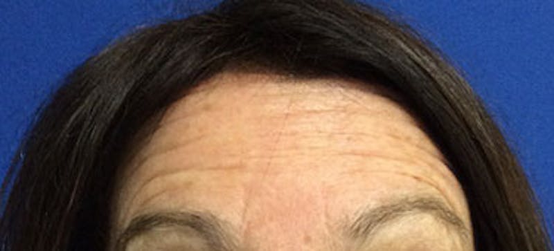 BOTOX Before & After Gallery - Patient 240107 - Image 1