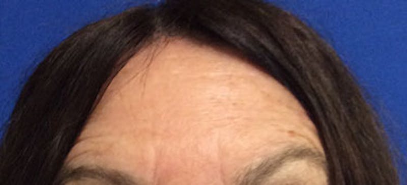 BOTOX Before & After Gallery - Patient 240107 - Image 2