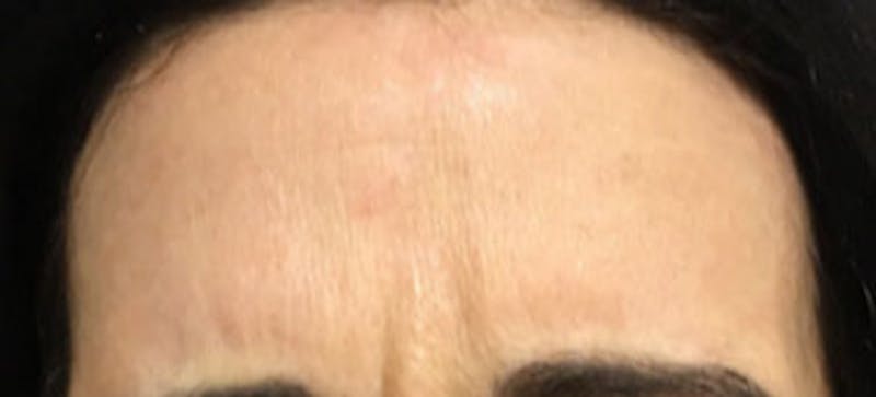 BOTOX Before & After Gallery - Patient 424043 - Image 1