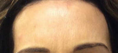 BOTOX Before & After Gallery - Patient 424043 - Image 2