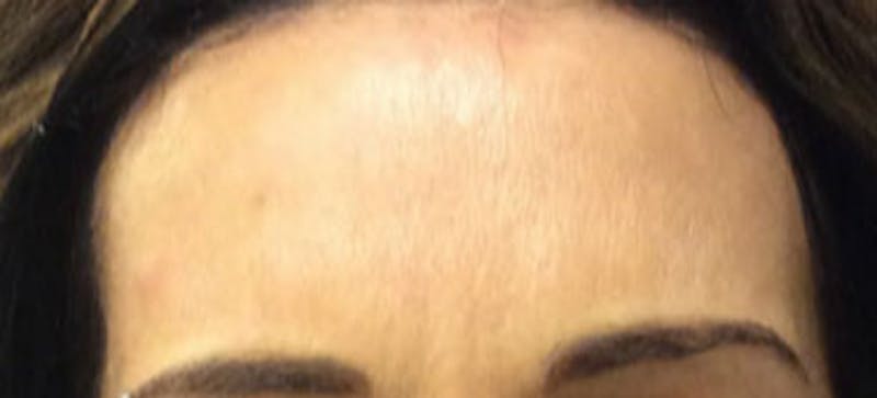 BOTOX Before & After Gallery - Patient 424043 - Image 2