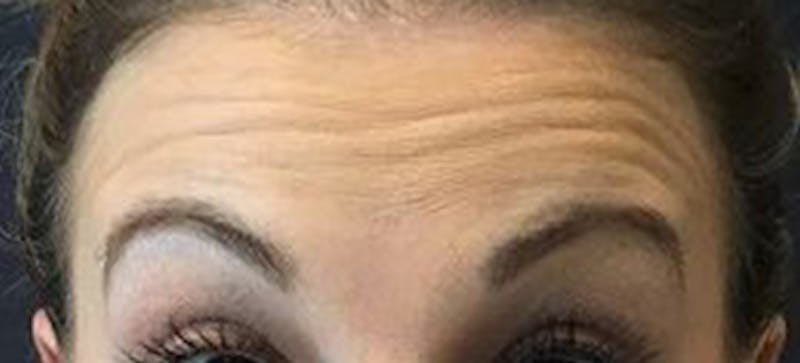 BOTOX Before & After Gallery - Patient 548806 - Image 1