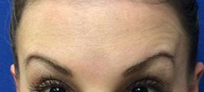 BOTOX Before & After Gallery - Patient 548806 - Image 2