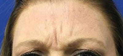 BOTOX Before & After Gallery - Patient 148574 - Image 1
