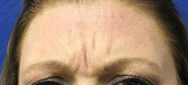 BOTOX Before & After Gallery - Patient 148574 - Image 1