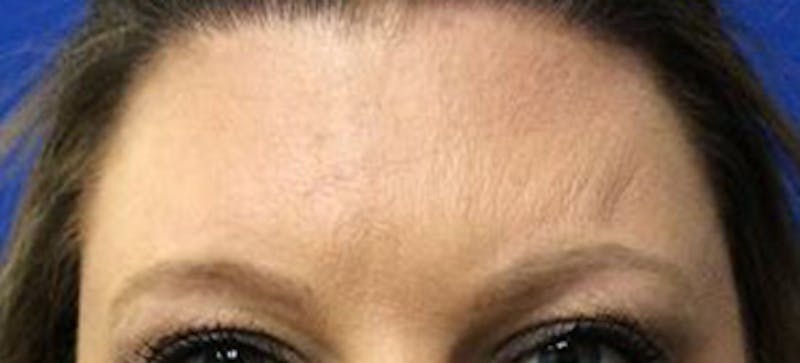 BOTOX Before & After Gallery - Patient 148574 - Image 2