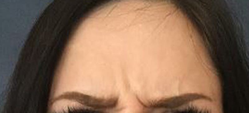BOTOX Before & After Gallery - Patient 103843 - Image 1