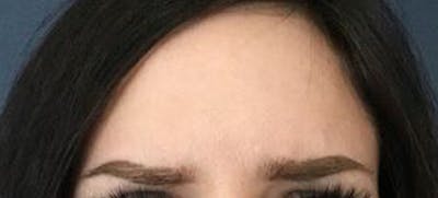 BOTOX Before & After Gallery - Patient 103843 - Image 2