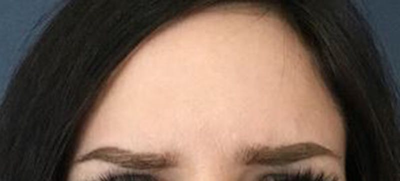 BOTOX Before & After Gallery - Patient 103843 - Image 2