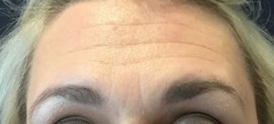 BOTOX Before & After Gallery - Patient 378069 - Image 1