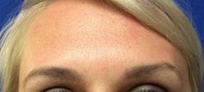 BOTOX Before & After Gallery - Patient 378069 - Image 2
