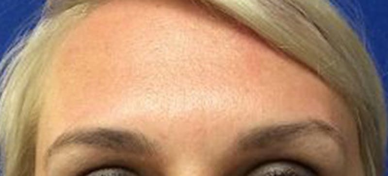 BOTOX Before & After Gallery - Patient 378069 - Image 2