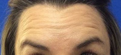 BOTOX Before & After Gallery - Patient 177141 - Image 1