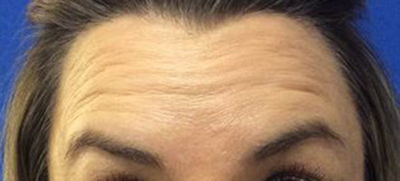 BOTOX Before & After Gallery - Patient 177141 - Image 1