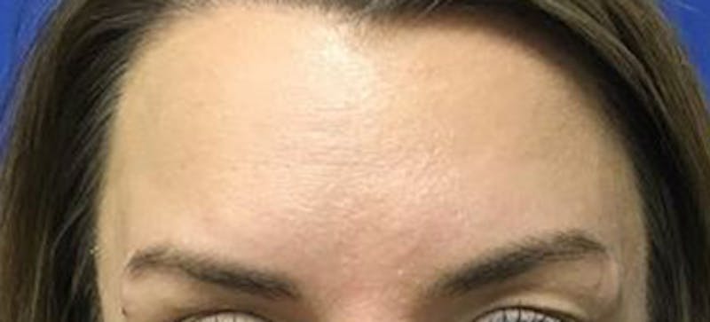 BOTOX Before & After Gallery - Patient 177141 - Image 2