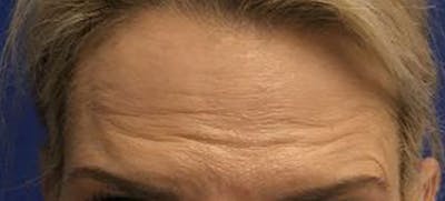 BOTOX Before & After Gallery - Patient 344658 - Image 1
