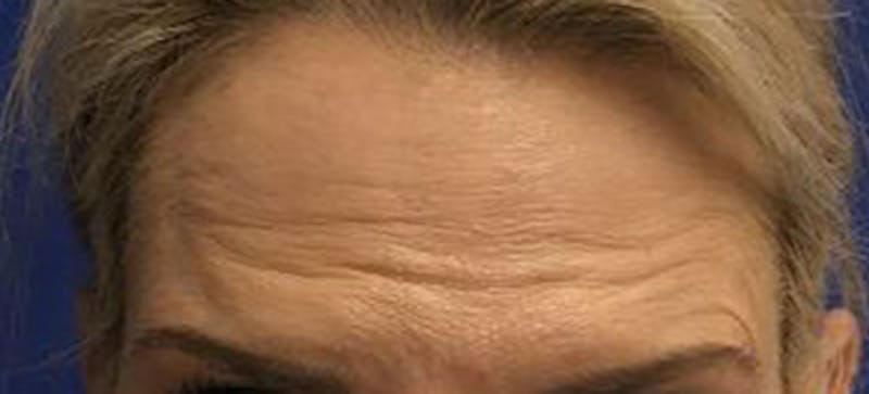 BOTOX Before & After Gallery - Patient 344658 - Image 1
