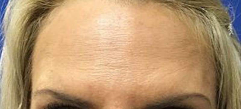 BOTOX Before & After Gallery - Patient 344658 - Image 2