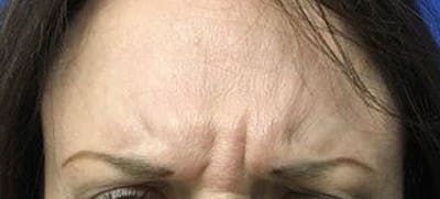 BOTOX Before & After Gallery - Patient 156672 - Image 1