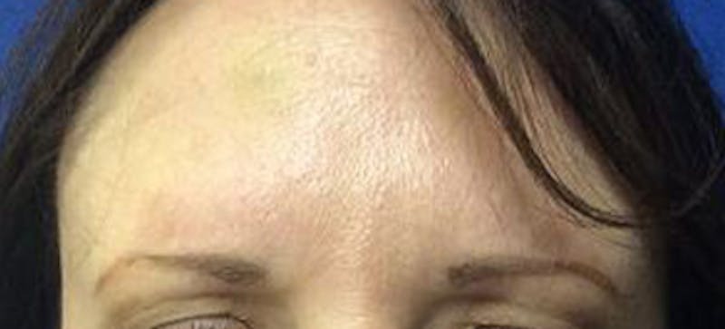 BOTOX Before & After Gallery - Patient 156672 - Image 2