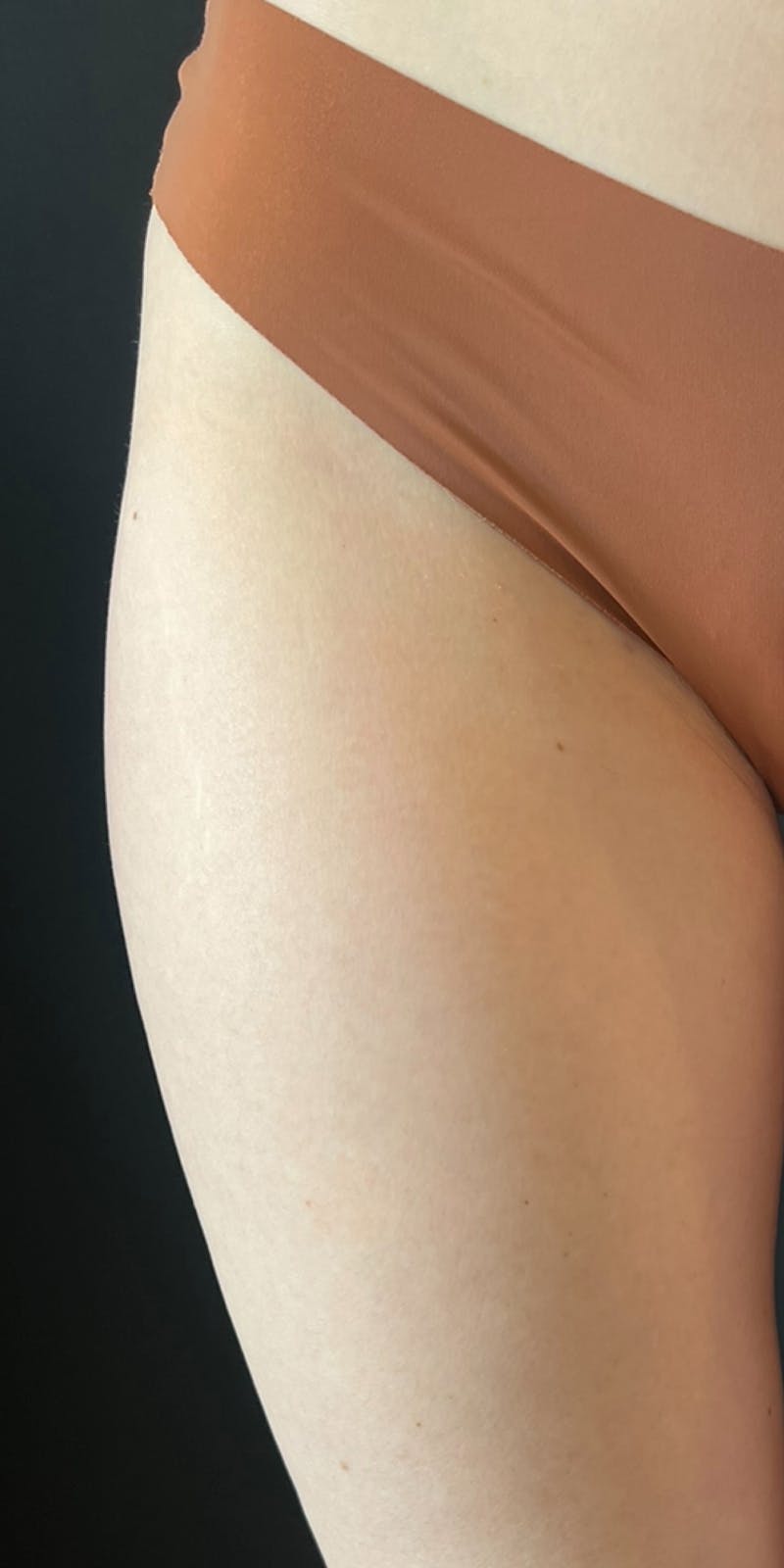 Radiesse Before & After Gallery - Patient 123349 - Image 1