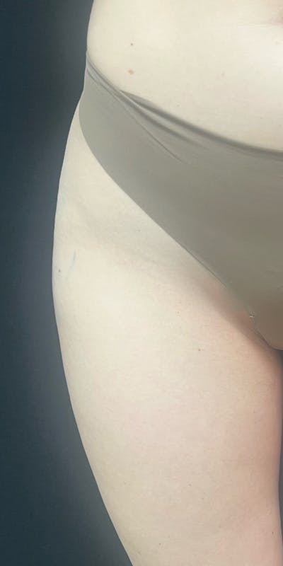 Radiesse Before & After Gallery - Patient 123349 - Image 2