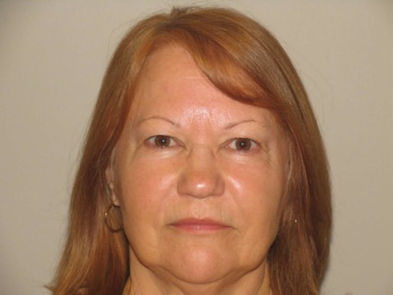Bellafill Before & After Gallery - Patient 261443 - Image 1
