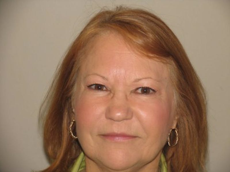 Bellafill Before & After Gallery - Patient 261443 - Image 2
