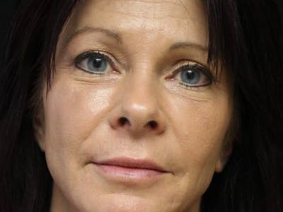 Bellafill Before & After Gallery - Patient 257686 - Image 1