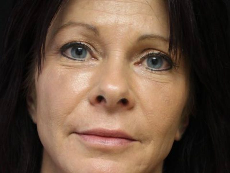 Bellafill Before & After Gallery - Patient 257686 - Image 1