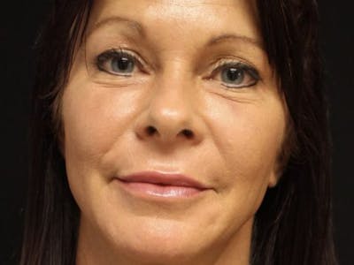 Bellafill Before & After Gallery - Patient 257686 - Image 2