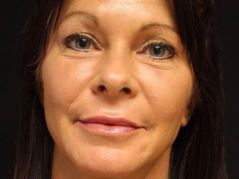 Bellafill Before & After Gallery - Patient 257686 - Image 2
