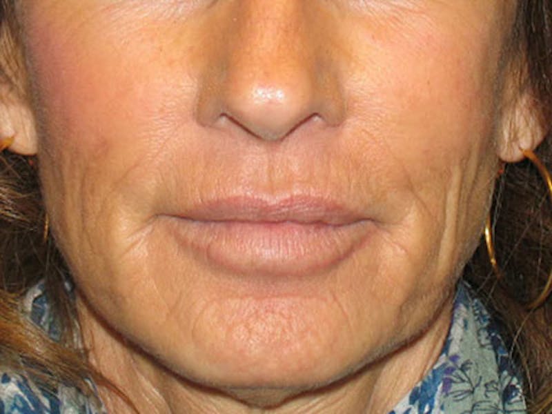 Bellafill Before & After Gallery - Patient 398734 - Image 1