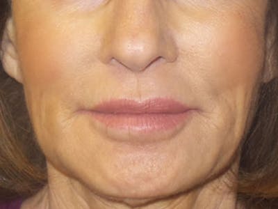 Bellafill Before & After Gallery - Patient 398734 - Image 2